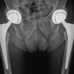 protesi totale dell'anca
