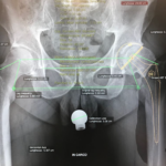 Ricostruzione della geometria articolare dell'anca