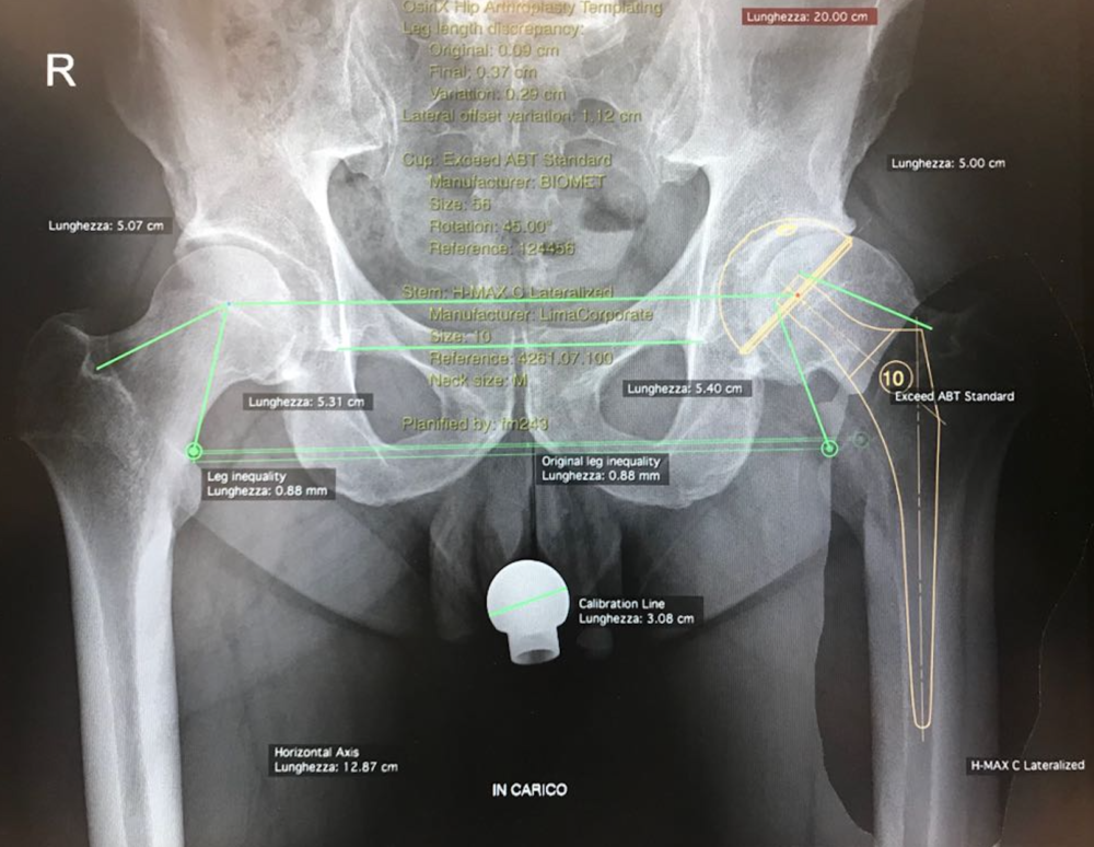 Ricostruzione della geometria articolare dell'anca