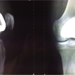 monocompartimentale ginocchio effettuata dal primario dell'unità funzionale ortopedia dell'humanitas gavazzeni dott Francesco Verde