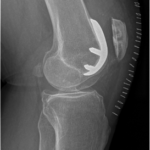 protesi femoro rotulea, effettuata dal primario dell'unità funzionale ortopedia dell'humanitas gavazzeni dott Francesco Verde