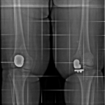 protesi monocompartimentale del ginocchio, dotto Francesco Verde primario dell'unità funzionale ortopedia ospedale humanitas gavazzeni