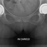 protesi totale anca bilaterale. è uno degli interventi effettuati dal primario dell' unità funzionale chirurgica di ortopedia presso Humanitas Gavazzeni