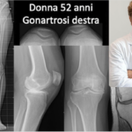 protesi-bimonocompartimentale-francesco-verde