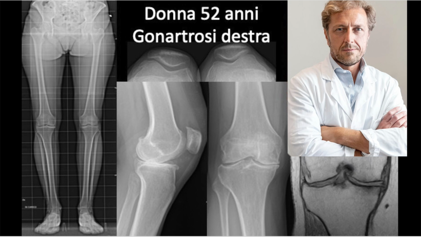 protesi-bimonocompartimentale-francesco-verde